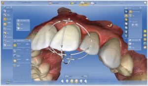 Cerec San Ramon Dentist