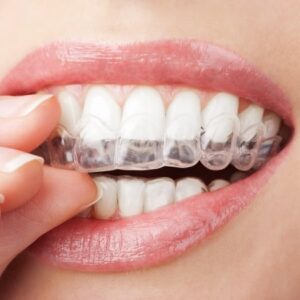 Clear Dental Aligners