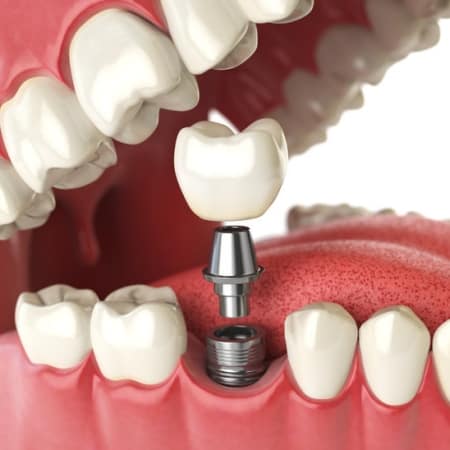 Dental Implants East Bay