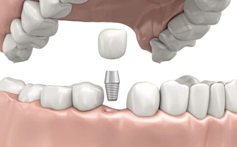 Dental Implants San Ramon