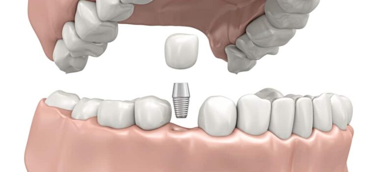 Dental Implants San Ramon