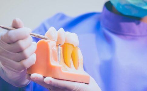Dental Implants San Ramon