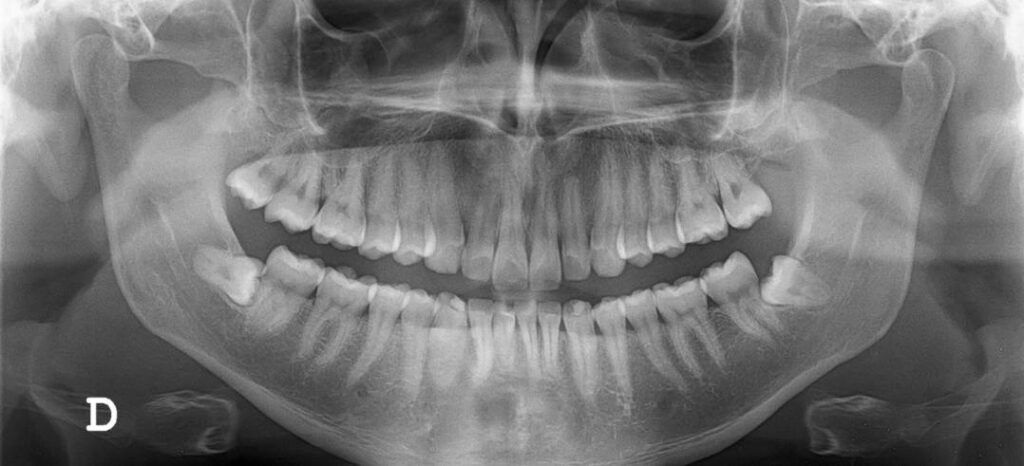 Digital Dental Xrays