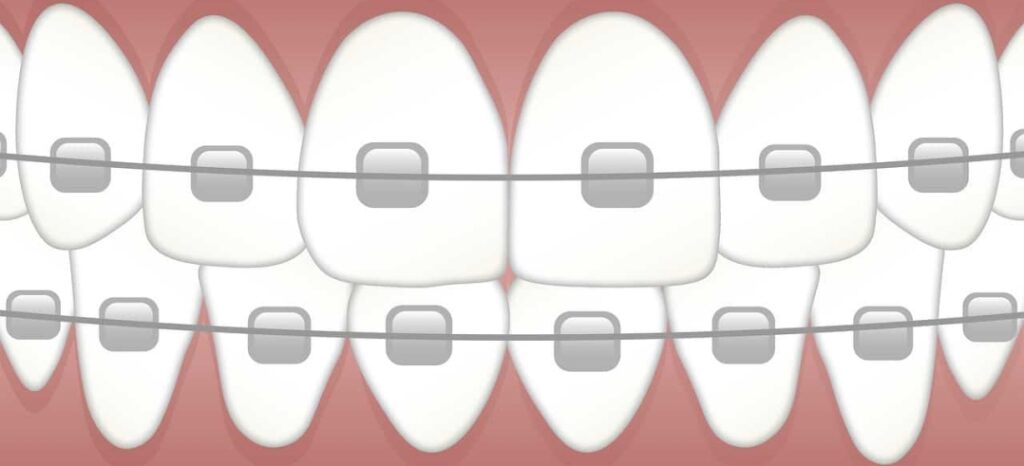 Healthy Teeth With Braces