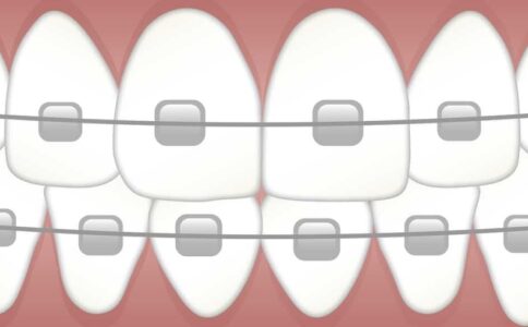 Healthy Teeth With Braces