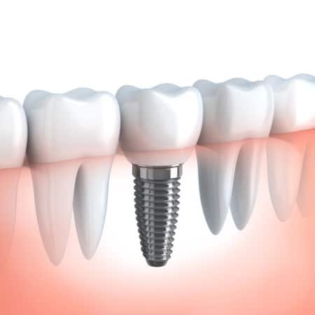 Implant Dentistry