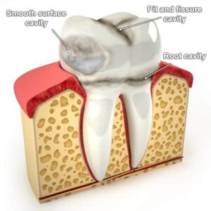 Prevent Cavities