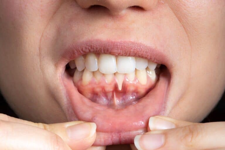 Receding Gum Treatment Receding Gum Treatment