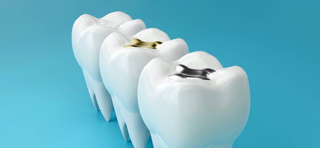 Remove Amalgam Fillings-Danville