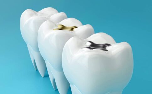 Remove Amalgam Fillings-Danville