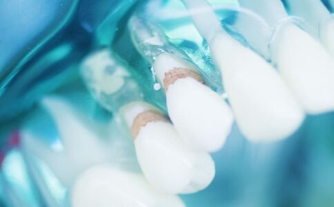 Tooth Erosion Dentist