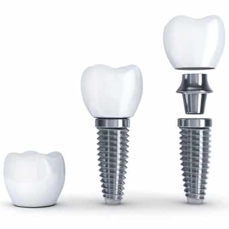 Tooth Implants