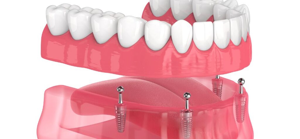 All On Four Dental Implants