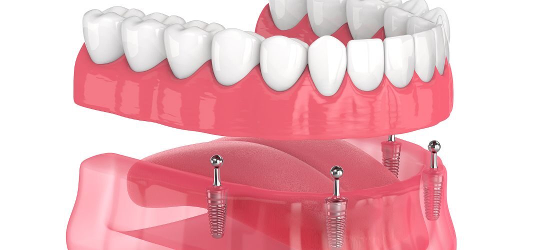 All-On-4® Dental Implants