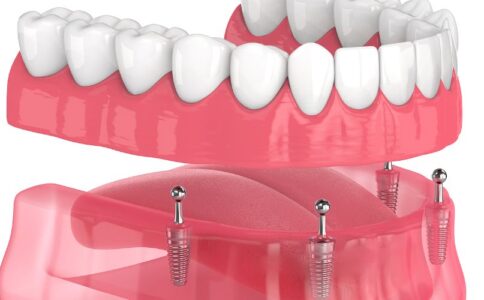 All-On-4® Dental Implants