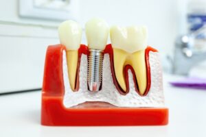 Care For Dental Implants Care For Dental Implants