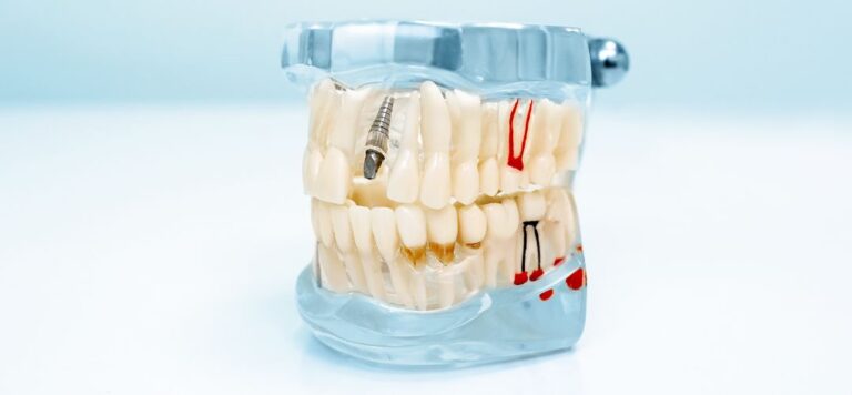 Common Myths Facts About Dental Implants Dental Implant Model Showing Tooth Replacement With Metal Implant Fixture And Prosthetic Crown.