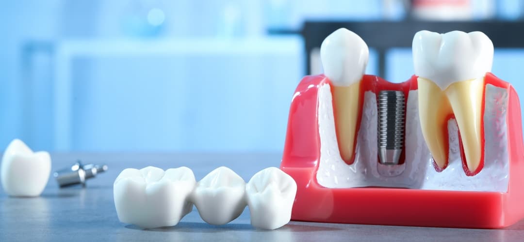 Dental Bridges San Ramon, CA Pro Smile Dental Care