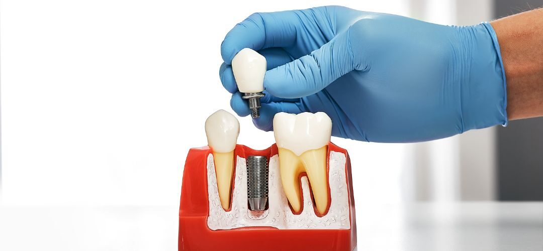 A dentist shows a patient what a dental implant is with an education model.