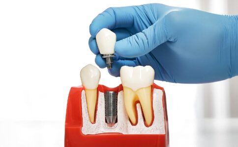 A dentist shows a patient what a dental implant is with an education model.