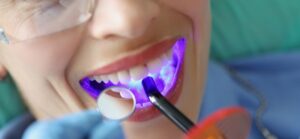 dental-sealants