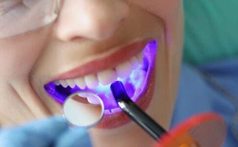 dental-sealants