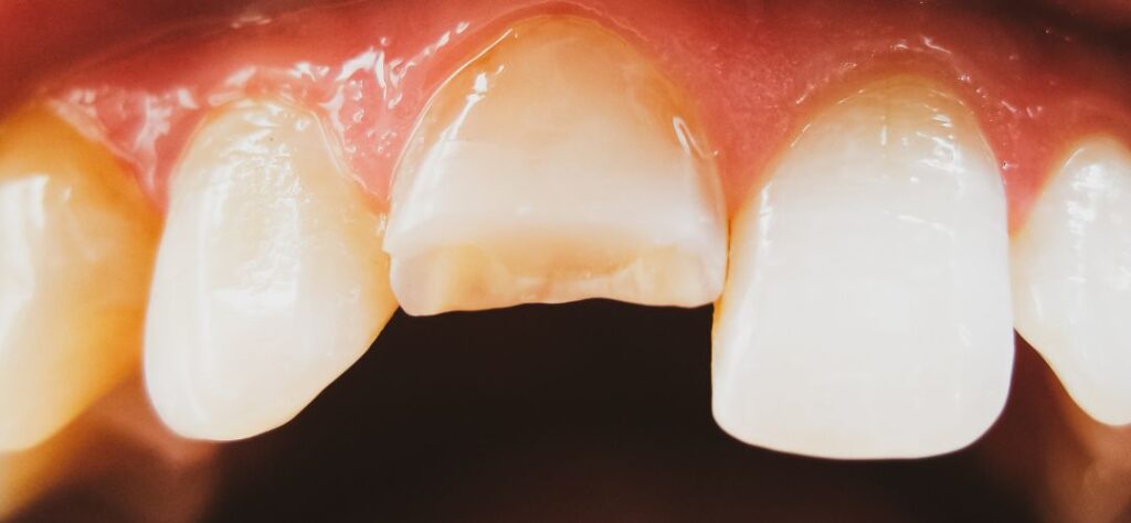 Repairing A Chipped Tooth