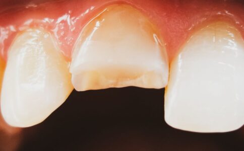 fixing-chipped-cracked-teeth