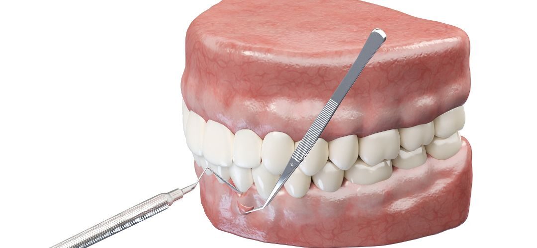 gum-and-bone-grafts