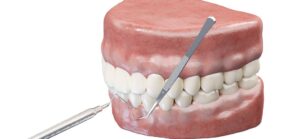 gum-and-bone-grafts