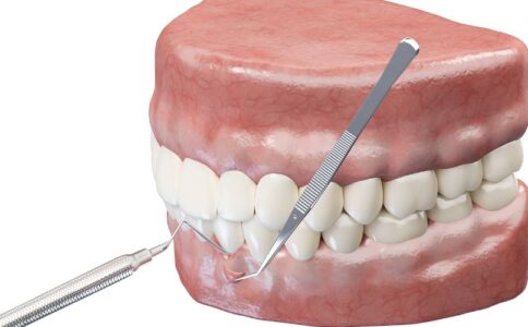 gum-and-bone-grafts