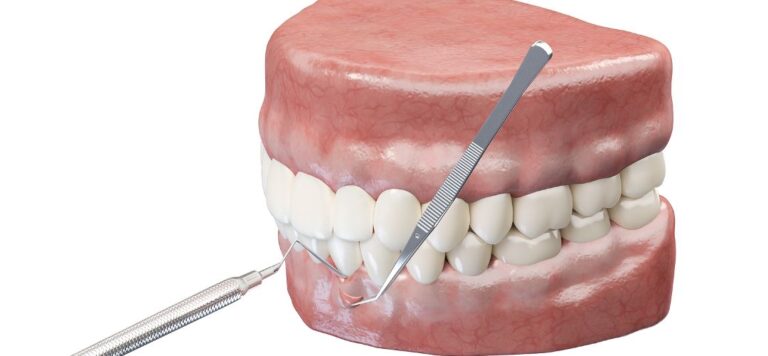 Gum-And-Bone-Grafts