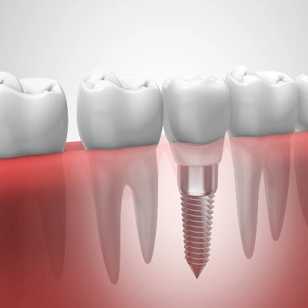img Implant Dentistry