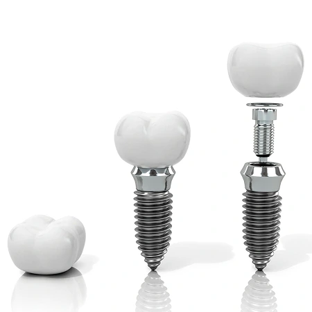 img Tooth Implants