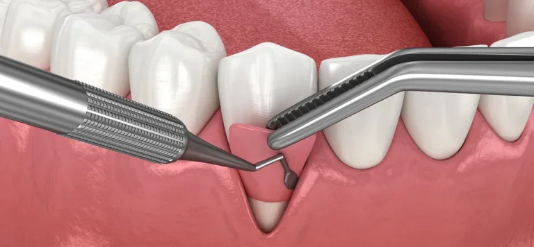 Gum & Bone Grafts