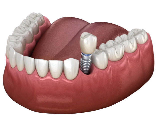 img what to expect from the implant process mobile