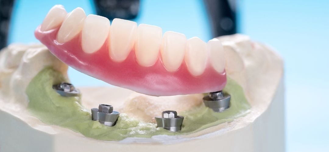 implant-supported-dentures