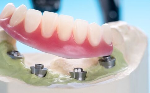 implant-supported-dentures