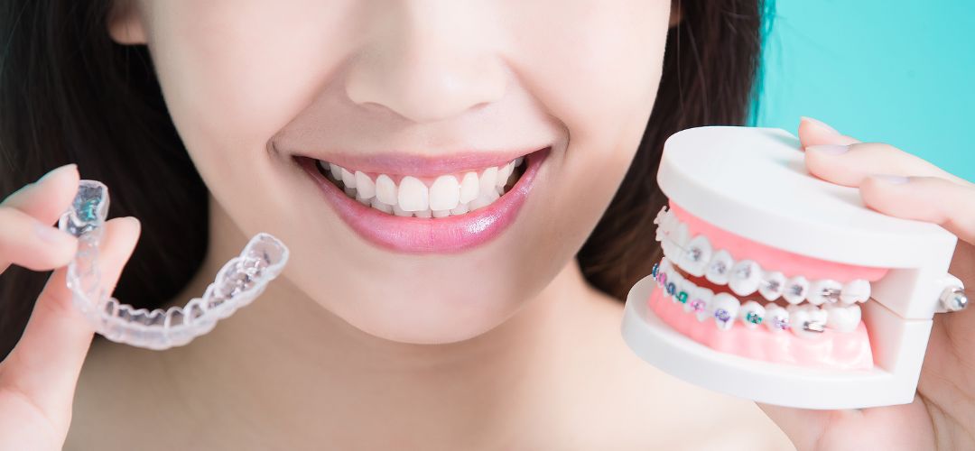 Invisalign Vs Ceramic Braces San Ramon, CA Pro Smile Dental Care