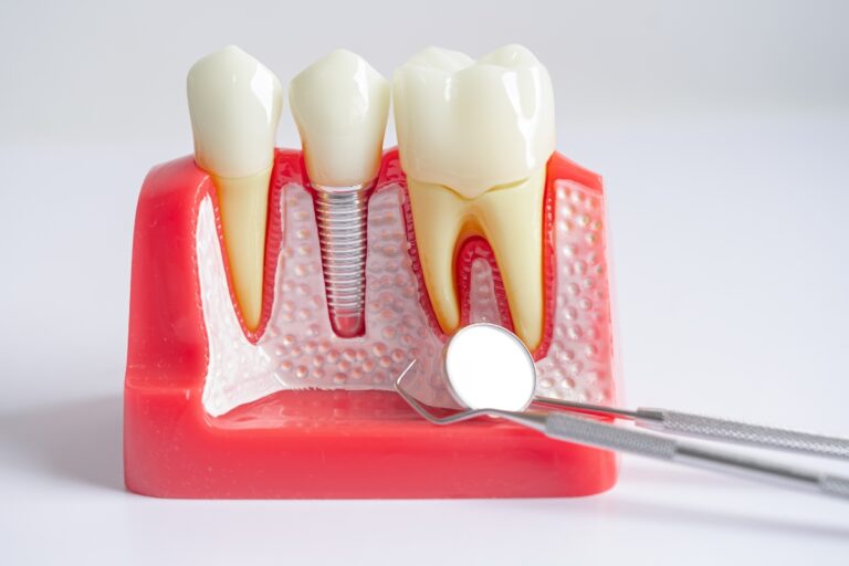 permanent tooth replacement