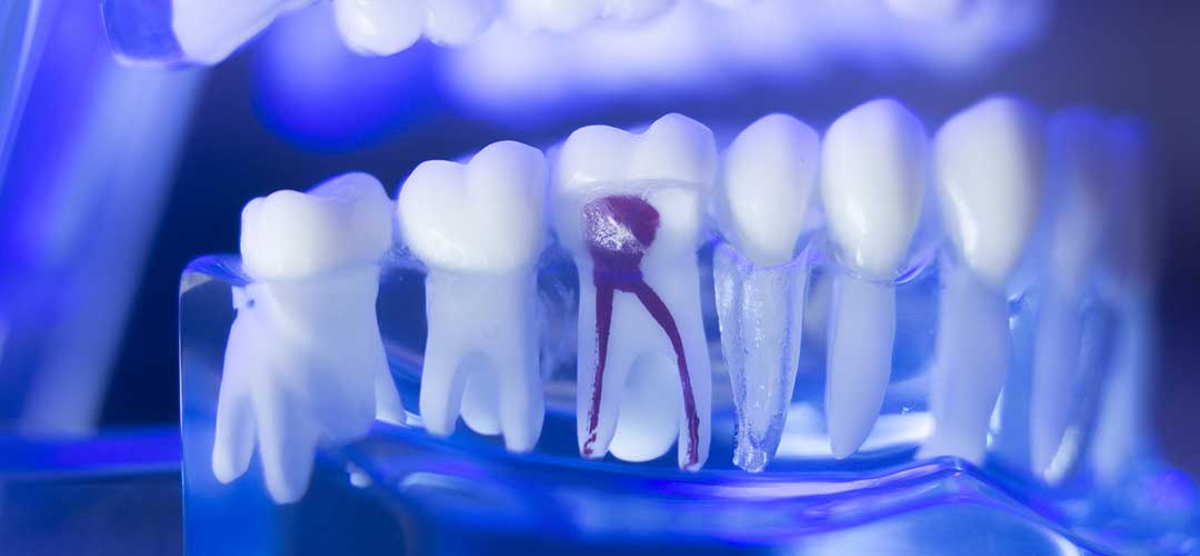 Root Canal Treatment San Ramon, CA Pro Smile Dental Care